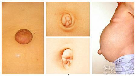 成人脐疝土方治疗视频