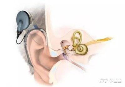 成人怎么带耳蜗耳塞视频,成人操作指南