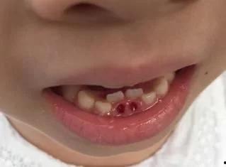 成人乳牙根处理方法视频,成人乳牙根处理技巧解析